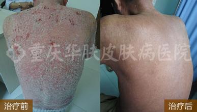 重庆人民医院皮肤科治疗皮肤病如何